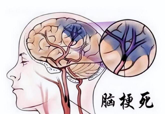 女保洁干活突发脑梗称是因雇主冰箱太臭？要求雇爱体育平台主拿70%医药费(图5)